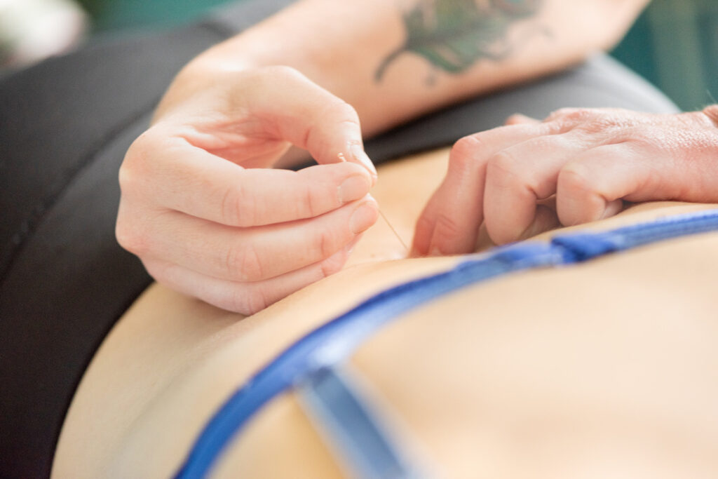 Dry Needling