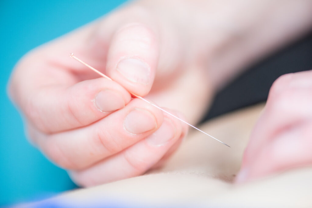 Dry Needling